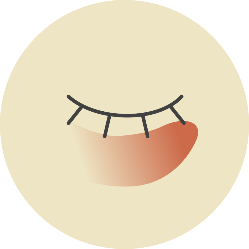 2. Vascular dark circles