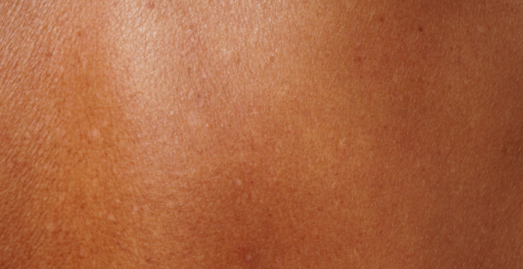 sun allergy symptoms ISDIN