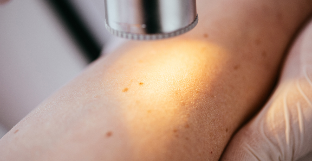 Dermoscope and skin