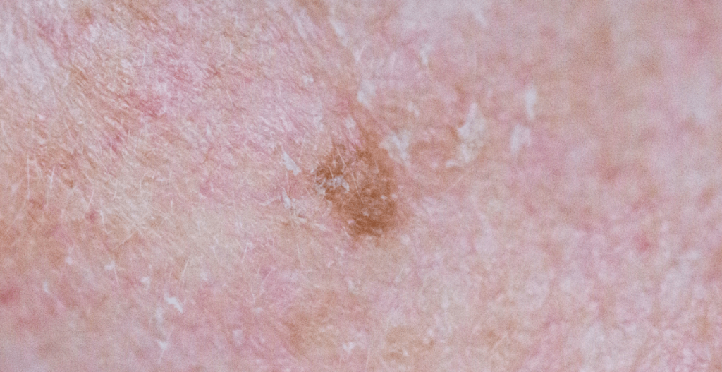 What does actinic keratosis look like