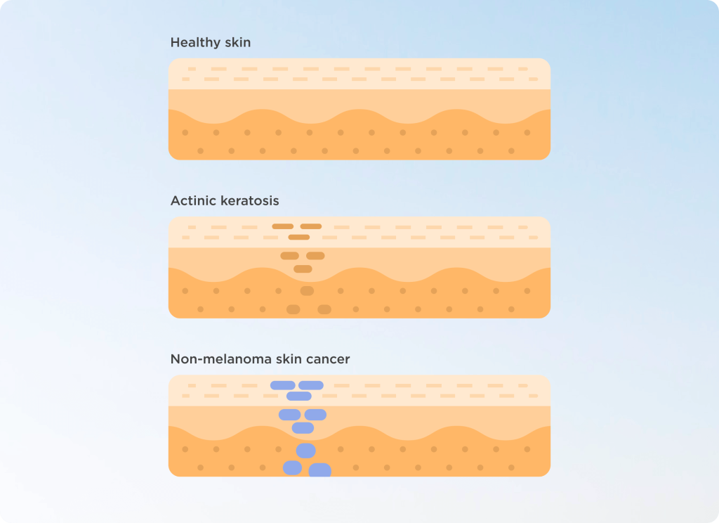 What is actinic keratosis or actinic damage?