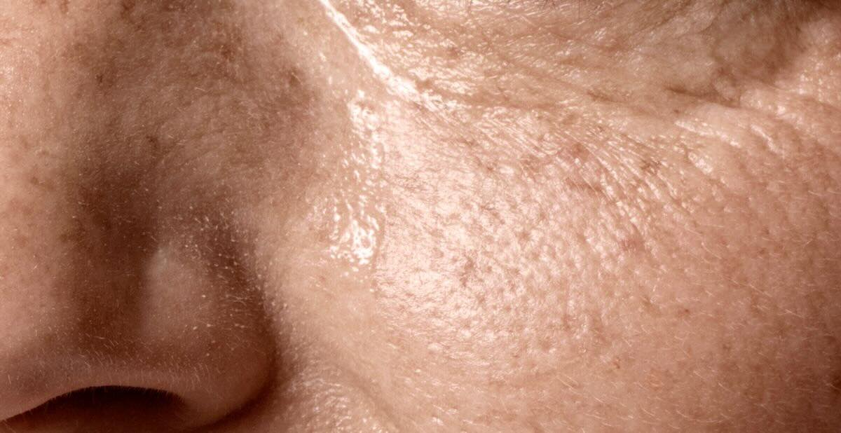 Dark spots on skin